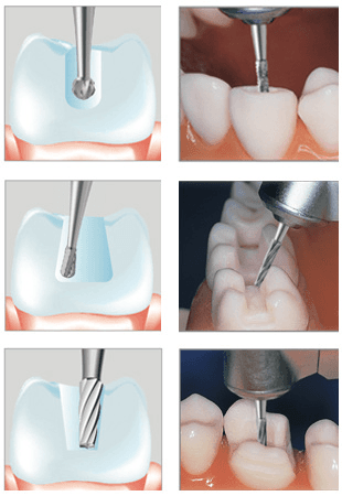 Tungsten carbide instruments for dentists